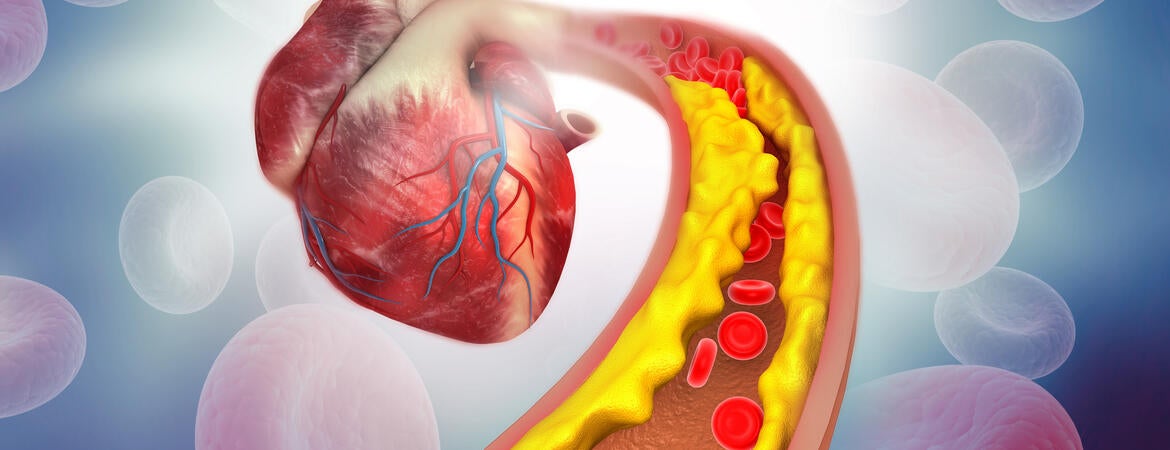 Cholesterol plaque in arteries