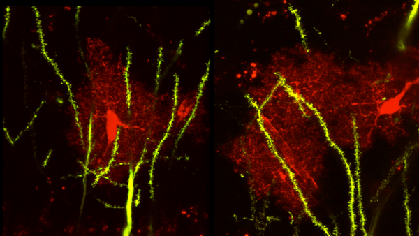 Hippocampus MRI