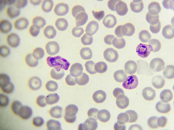 Malaria parasite in blood film