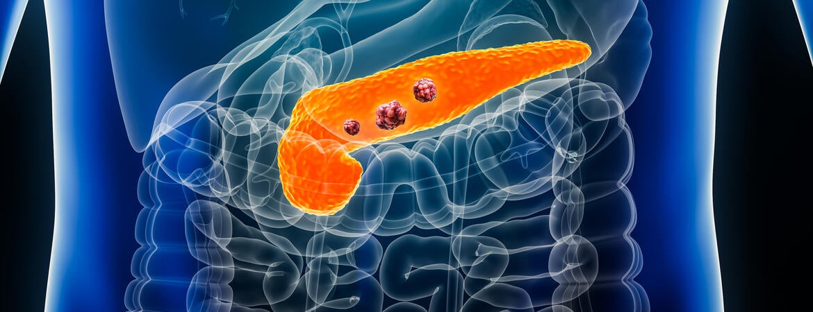 Pancreas or pancreatic cancer with organs and tumors or cancerous cells 3D rendering illustration with male body.