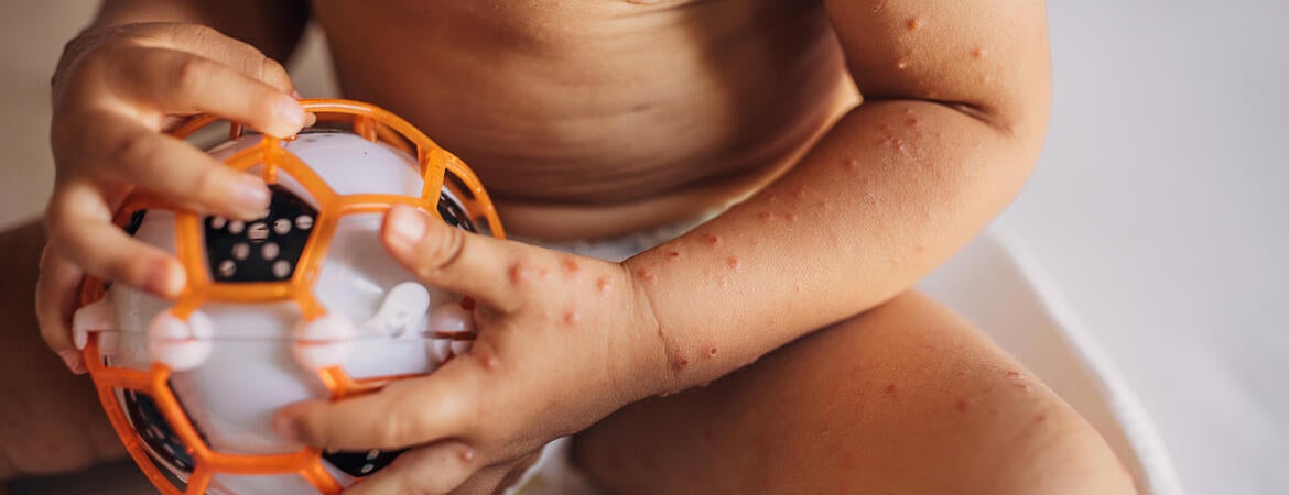 Child with Hand Foot Mouth Disease