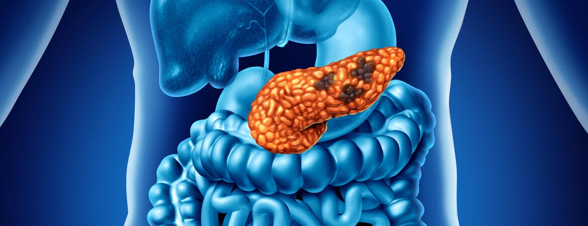 Human Pancreatic Cancer