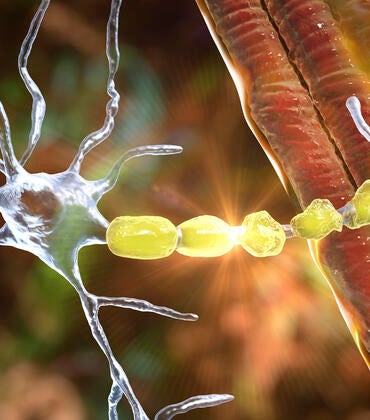 Demyelination of neuron