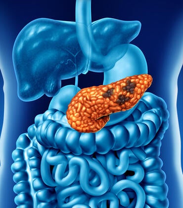 Human Pancreatic Cancer