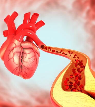 Cholesterol blocked artery