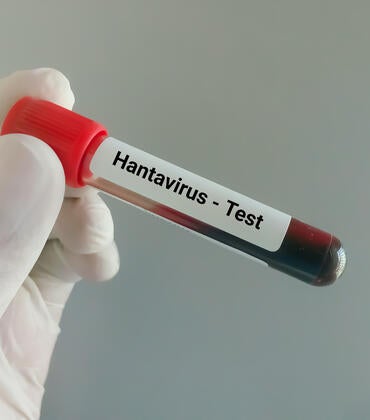 Blood sample for hantavirus test