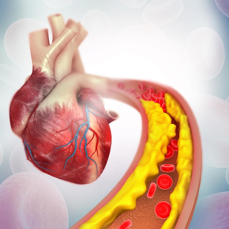 Cholesterol plaque in arteries