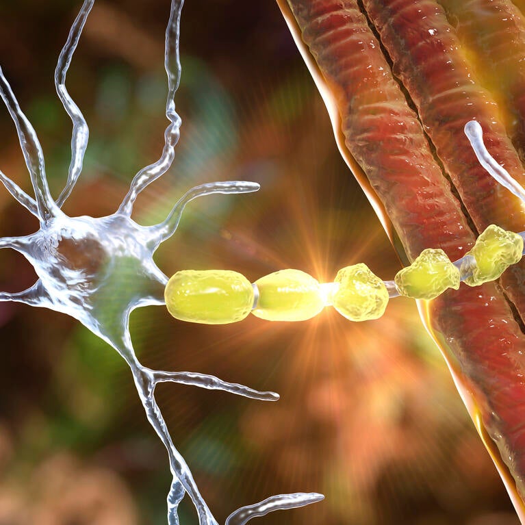 Demyelination of neuron