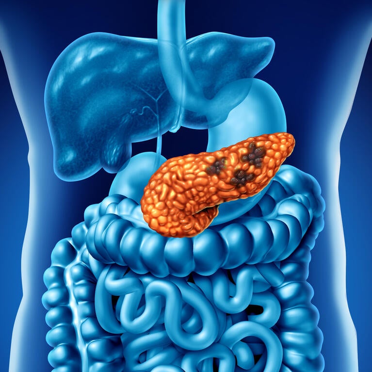Human Pancreatic Cancer