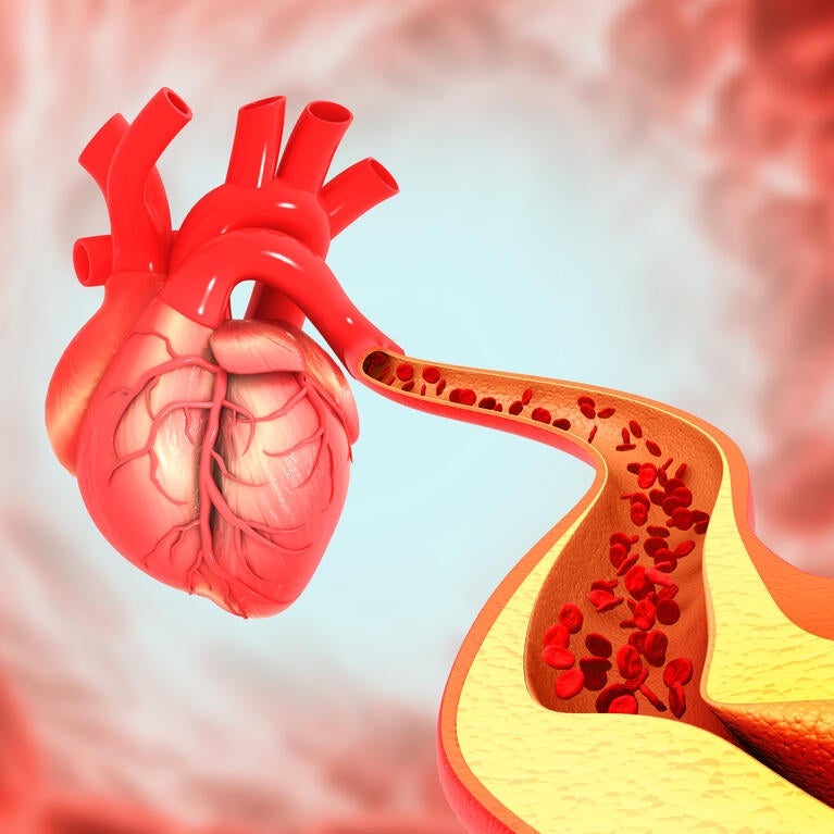 Cholesterol blocked artery