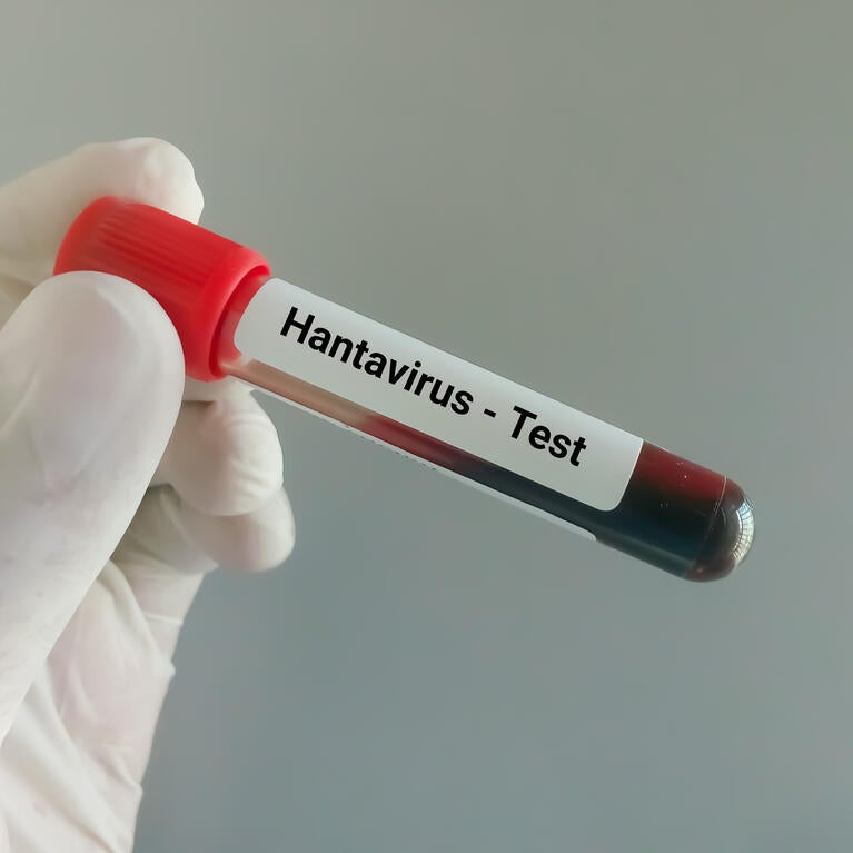 Blood sample for hantavirus test