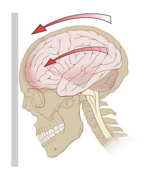 A diagram of the forces on the brain in concussion.