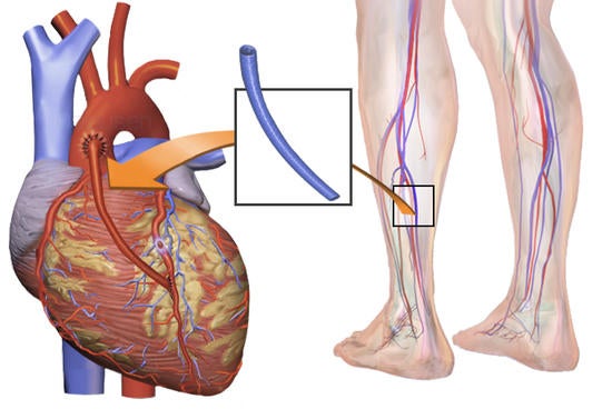 This illustration shows how a vein from the leg is used in a coronary artery bypass surgery. 